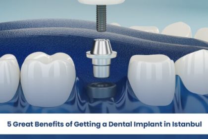 5-great-benefits-of-getting-a-dental-implant-in-istanbul