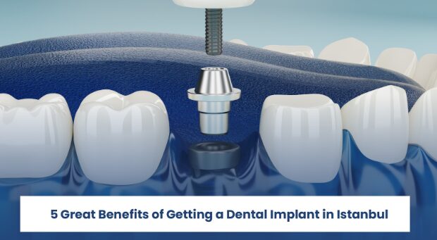 5-great-benefits-of-getting-a-dental-implant-in-istanbul