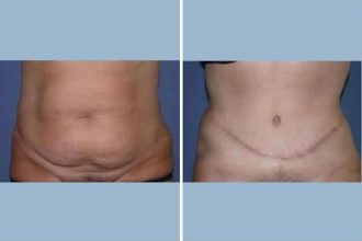 why-nyc-women-are-turning-to-tummy-tucks
