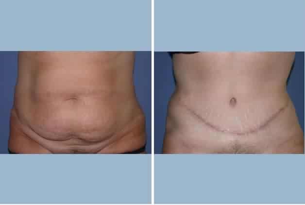 why-nyc-women-are-turning-to-tummy-tucks